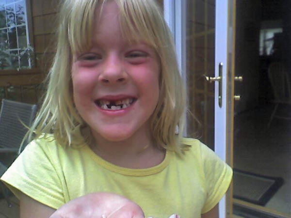 Lost another tooth ...